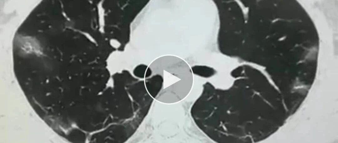 新冠病毒感染可导致哪些并发症？