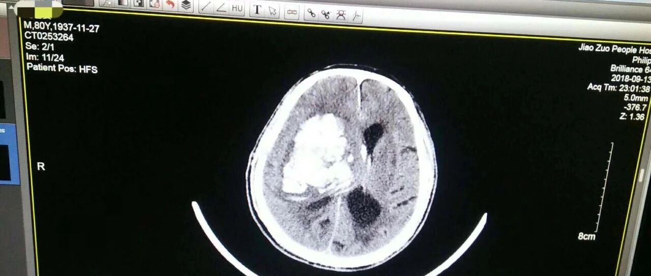 高血压患者如何才能避免脑出血？