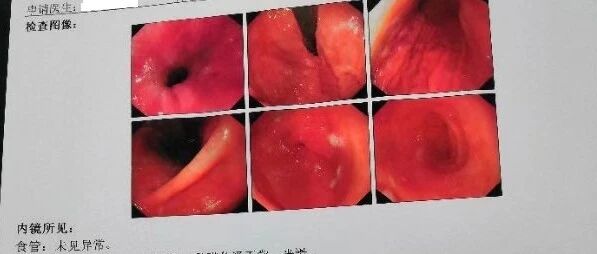 慢性萎缩性胃炎、轻度肠生化，有哪些特效治疗方法？