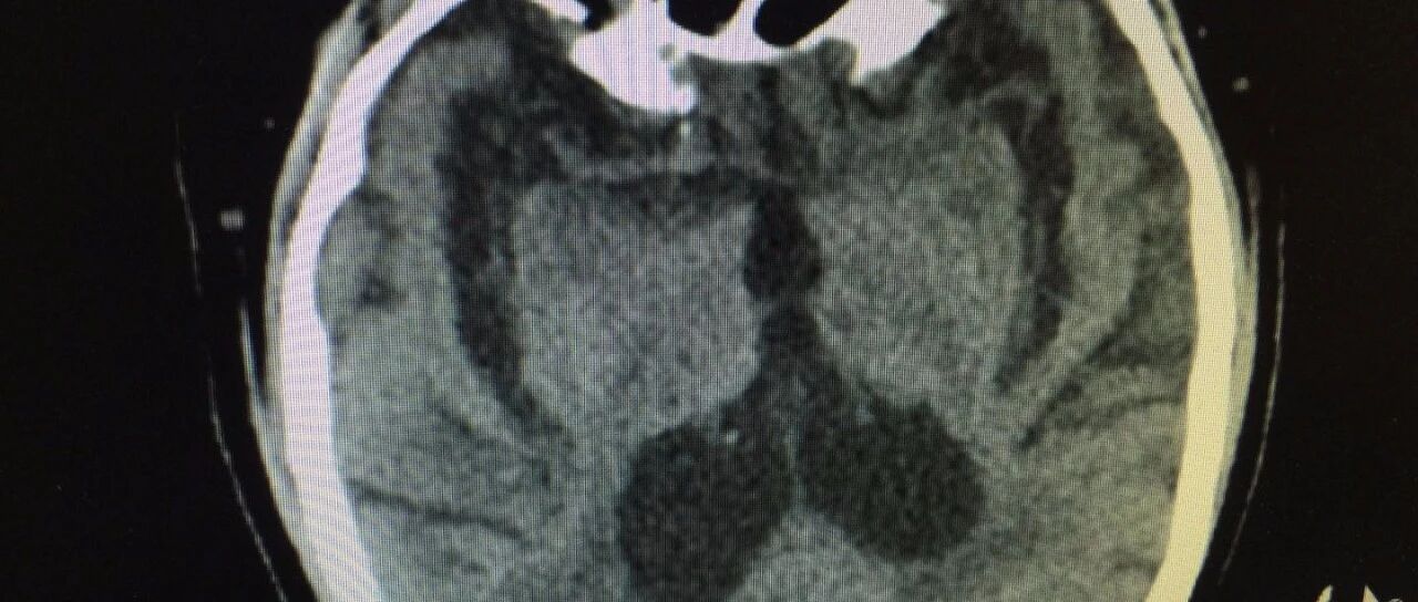 出现记忆力减退该怎么办？