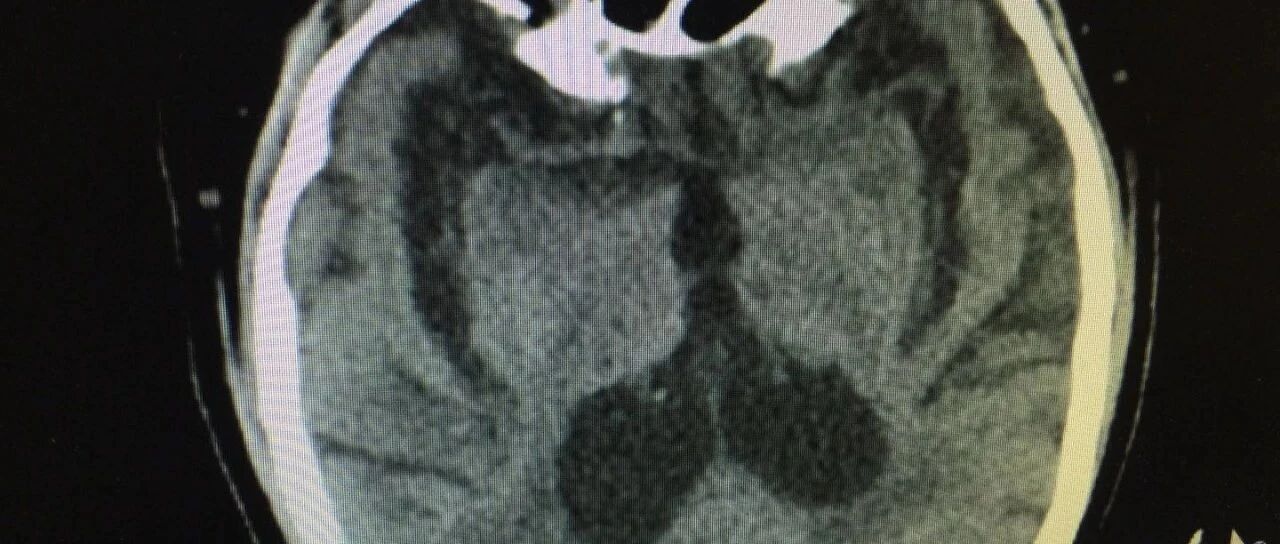 脑萎缩一般多大年龄会出现？该注意什么？