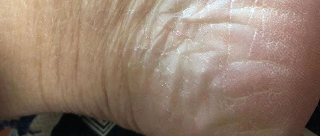 脚裂是什么原因？