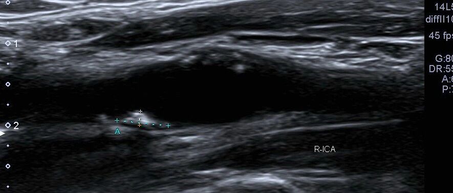 用什么检查方式才能发现自己得了颈动脉斑块？