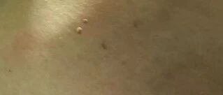 脖子上不断长出的“小肉球”是什么？可以扣掉吗？