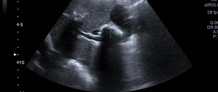 胆囊炎可以自愈吗？