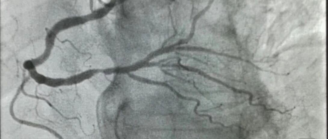 心脏血管堵塞50%需要终身吃药吗？生活中还要注意些什么？