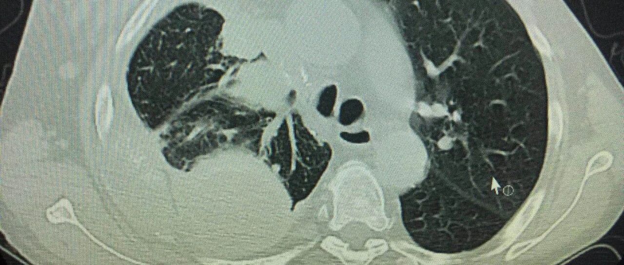 为什么同种癌症，有的患者六个月就走了，有人90岁依然活得很好？