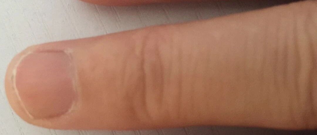 指甲表面有明显的竖纹是怎么回事？