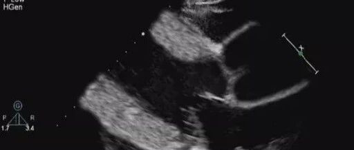 高血压病患者，如果血压长期不控制会对心脏有什么损害？