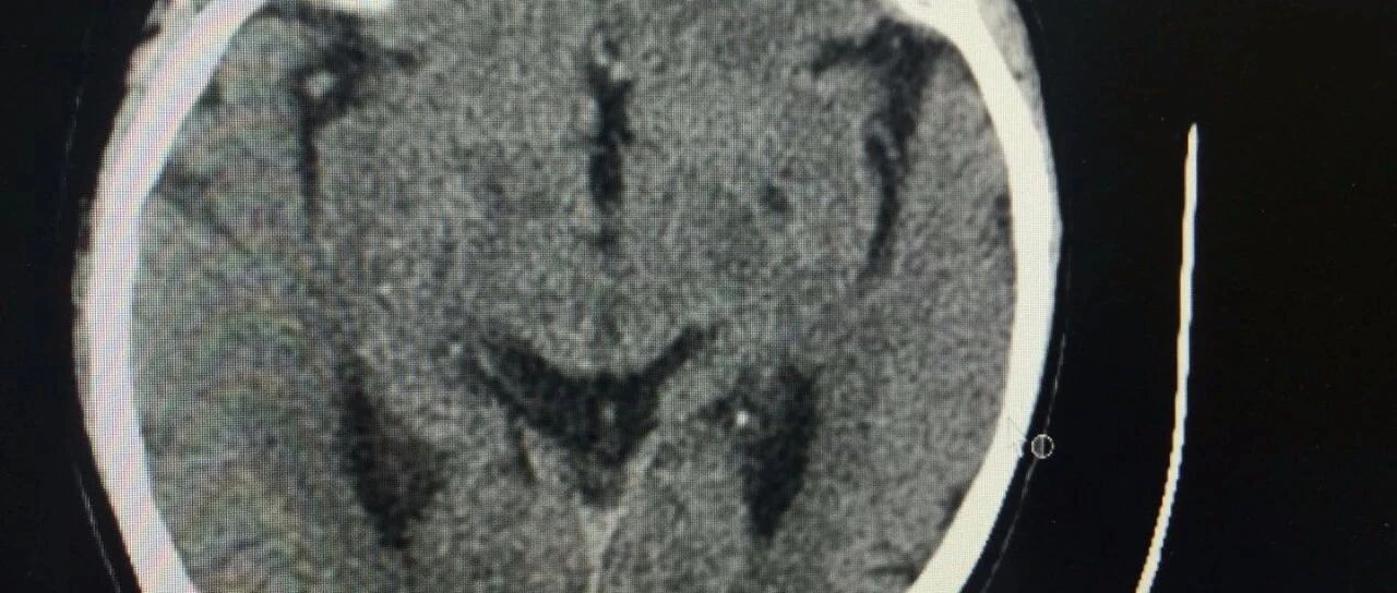 腔隙性脑梗塞有多大危害？和脑梗塞一样吗？
