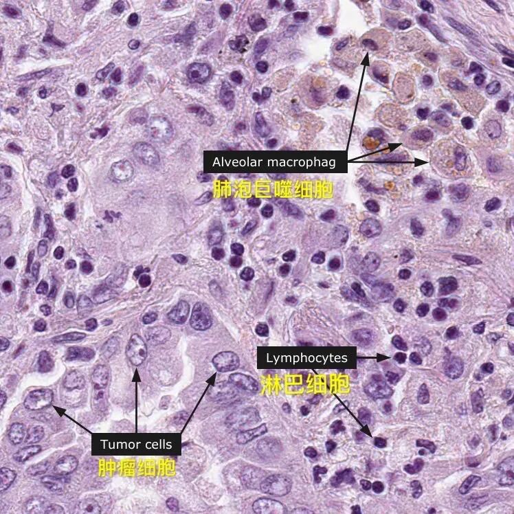 取病理什么意思病理报告为什么不能当天取？报告里的+-代表了什么？_https://www.jmylbn.com_新闻资讯_第4张