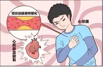 冠脉造影与心绞痛