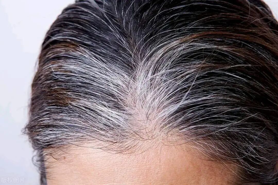 告别头发困扰：六个有效治疗头发早白、脱发、秃顶的用药方案