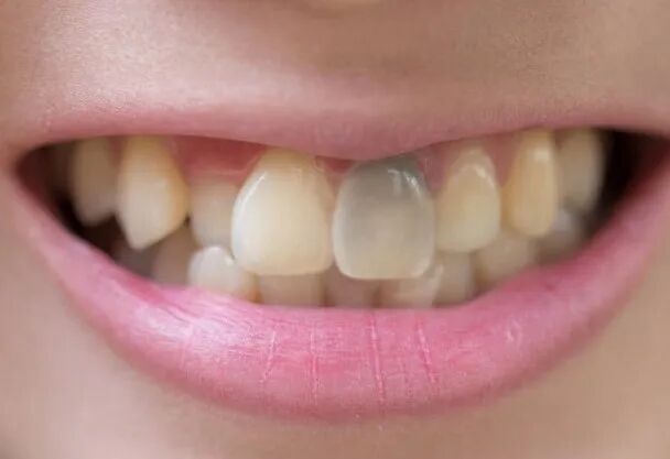 牙胶尖什么颜色港闸医院爱尔口腔｜牙齿发黑很难看？可能是牙髓坏死_https://www.jmylbn.com_新闻资讯_第1张