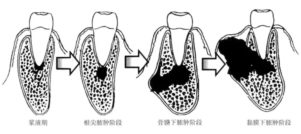 牙龈长包是怎么回事
