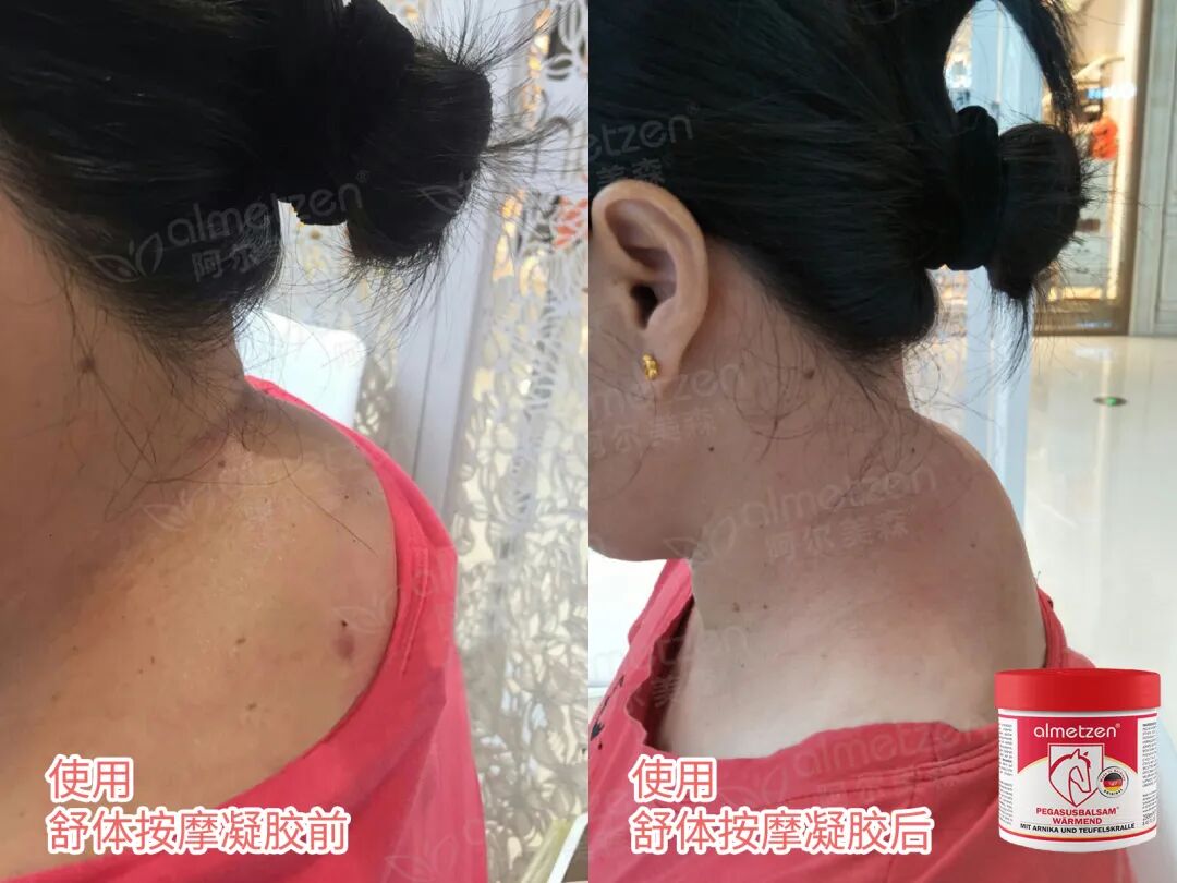 什么德国凝胶「德国阿尔美森舒体按摩凝胶」德国专业球员指定康复产品！凝胶自发热，5分钟缓解，欧盟品质安全温和_https://www.jmylbn.com_新闻资讯_第6张