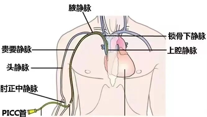 picc导管是什么材质肿瘤患者的血管伴侣----PICC_https://www.jmylbn.com_新闻资讯_第3张