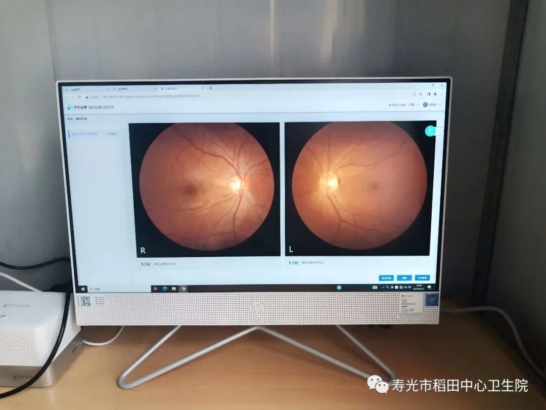 怎么躲过散瞳机【好消息】稻田中心卫生院新上拓普康TRC-NW400型免散瞳眼底照相机_https://www.jmylbn.com_新闻资讯_第4张