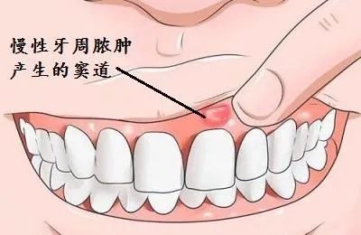 ​牙缝疙瘩，真的是上火吗？