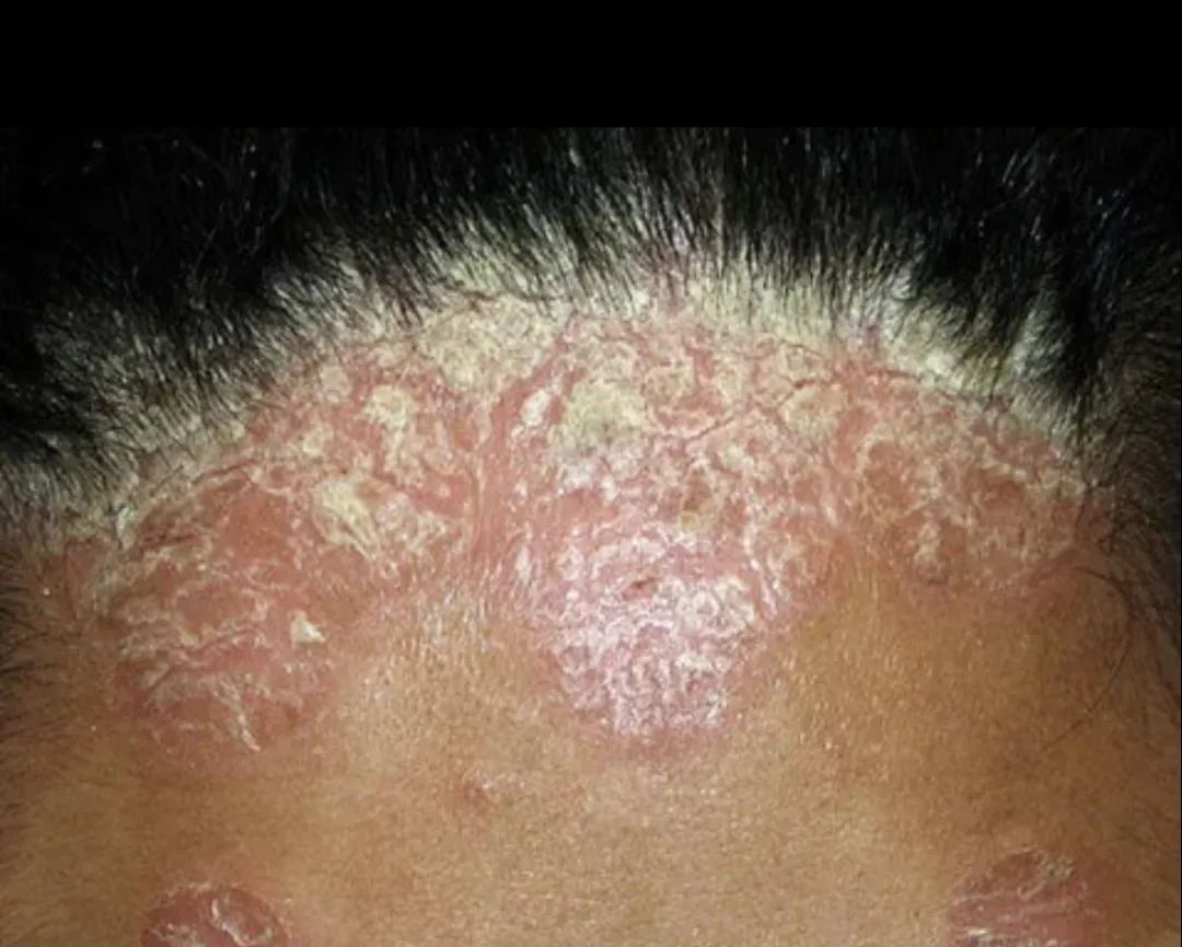 头皮银屑病和头皮脂溢性皮炎如何鉴别呢?