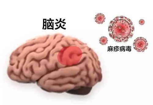 什么是散发性脑炎？—— 散发性脑炎科普全解