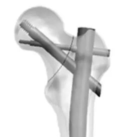 新型PFUN，会是粗隆间骨折内固定的更优解吗？