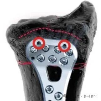 积水潭教程：桡骨远端骨折闭合整复石膏固定操作流程