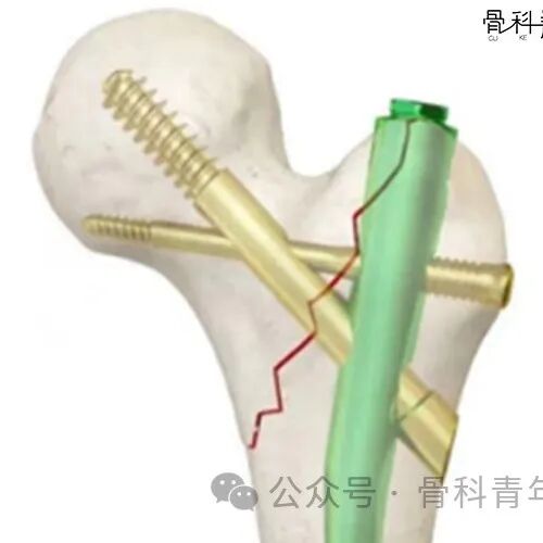 新型PFUN，会是粗隆间骨折内固定的更优解吗？