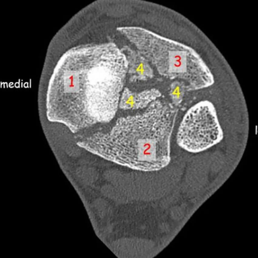Pilon骨折手术入路环：7种手术入路解析