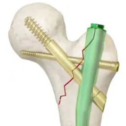 新型PFUN，会是粗隆间骨折内固定的更优解吗？
