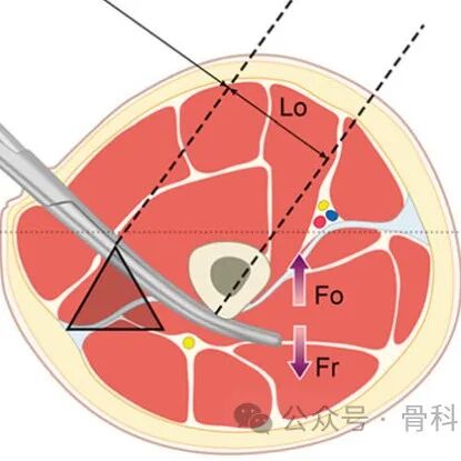 手术技巧｜“血管钳撬拨技术”辅助复位粗隆下骨折