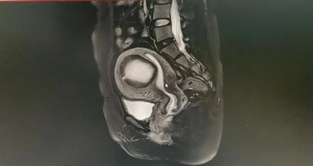 为什么叫哈巴狗钳手术新秀 ｜ 陈苑红：腹腔镜下阻断血管子宫肌瘤剔除术_https://www.jmylbn.com_新闻资讯_第3张