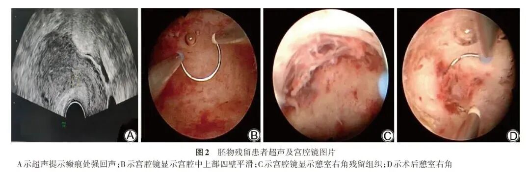 什么是宫腔组织吸引术宫腔观察吸引手术技术在剖宫产瘢痕妊娠治疗中应用的初探_https://www.jmylbn.com_新闻资讯_第5张