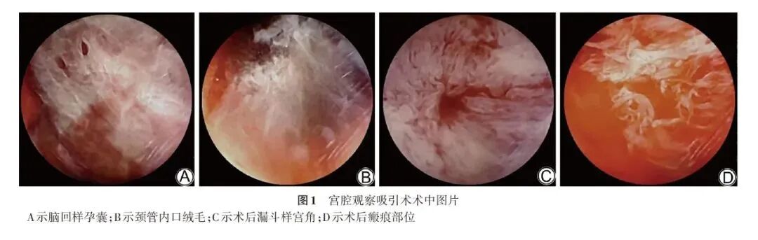 什么是宫腔组织吸引术宫腔观察吸引手术技术在剖宫产瘢痕妊娠治疗中应用的初探_https://www.jmylbn.com_新闻资讯_第2张