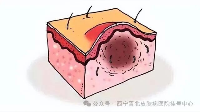 毛囊炎有哪些症状