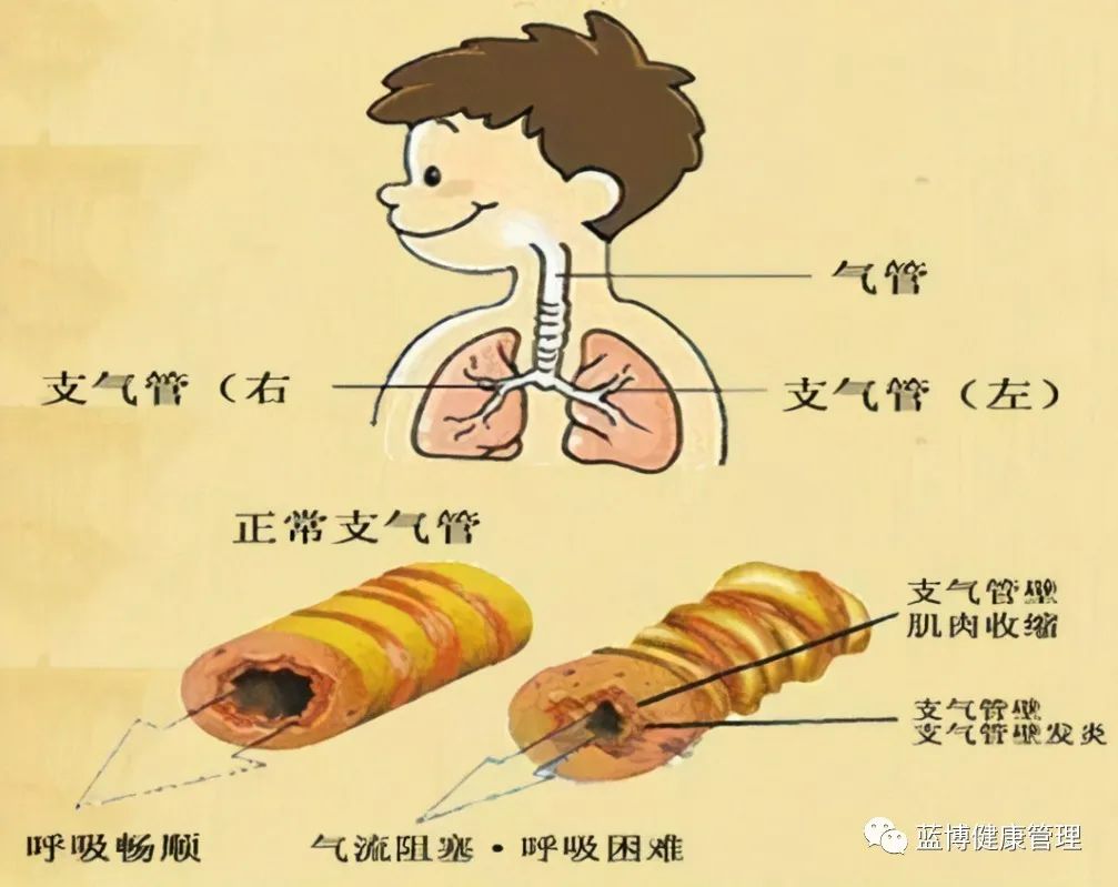 支气管炎-民间饮食疗法