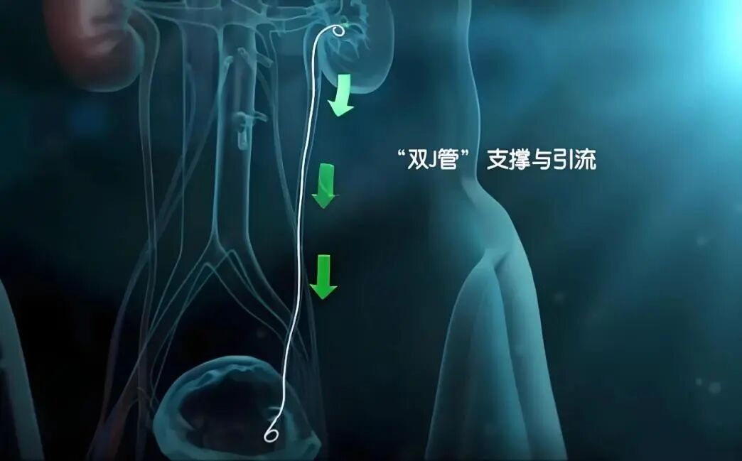 输尿管导管是什么小支架，大作用——泌尿系结石术后留置双J管患者出院指导_https://www.jmylbn.com_新闻资讯_第4张