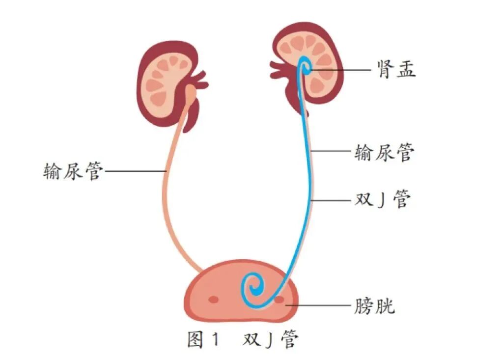 输尿管导管是什么小支架，大作用——泌尿系结石术后留置双J管患者出院指导_https://www.jmylbn.com_新闻资讯_第2张