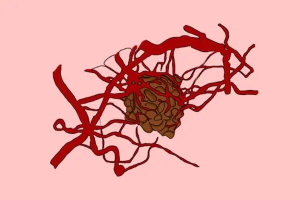胰腺癌生存率低，善于隐藏，医生：若是发现3个症状，需提高警惕
