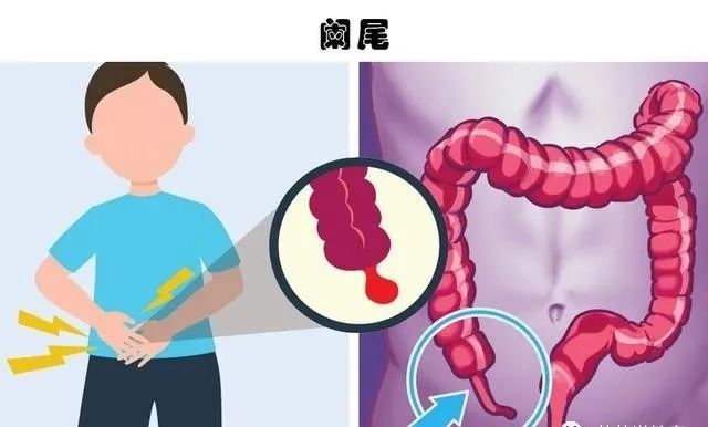 2、阑尾