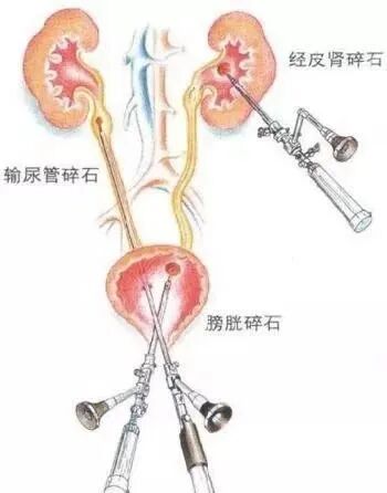 输尿管软镜有什么品牌泌尿外科输尿管镜钬激光碎石术：微创、高效的尿路结石治疗新选择_https://www.jmylbn.com_新闻资讯_第8张