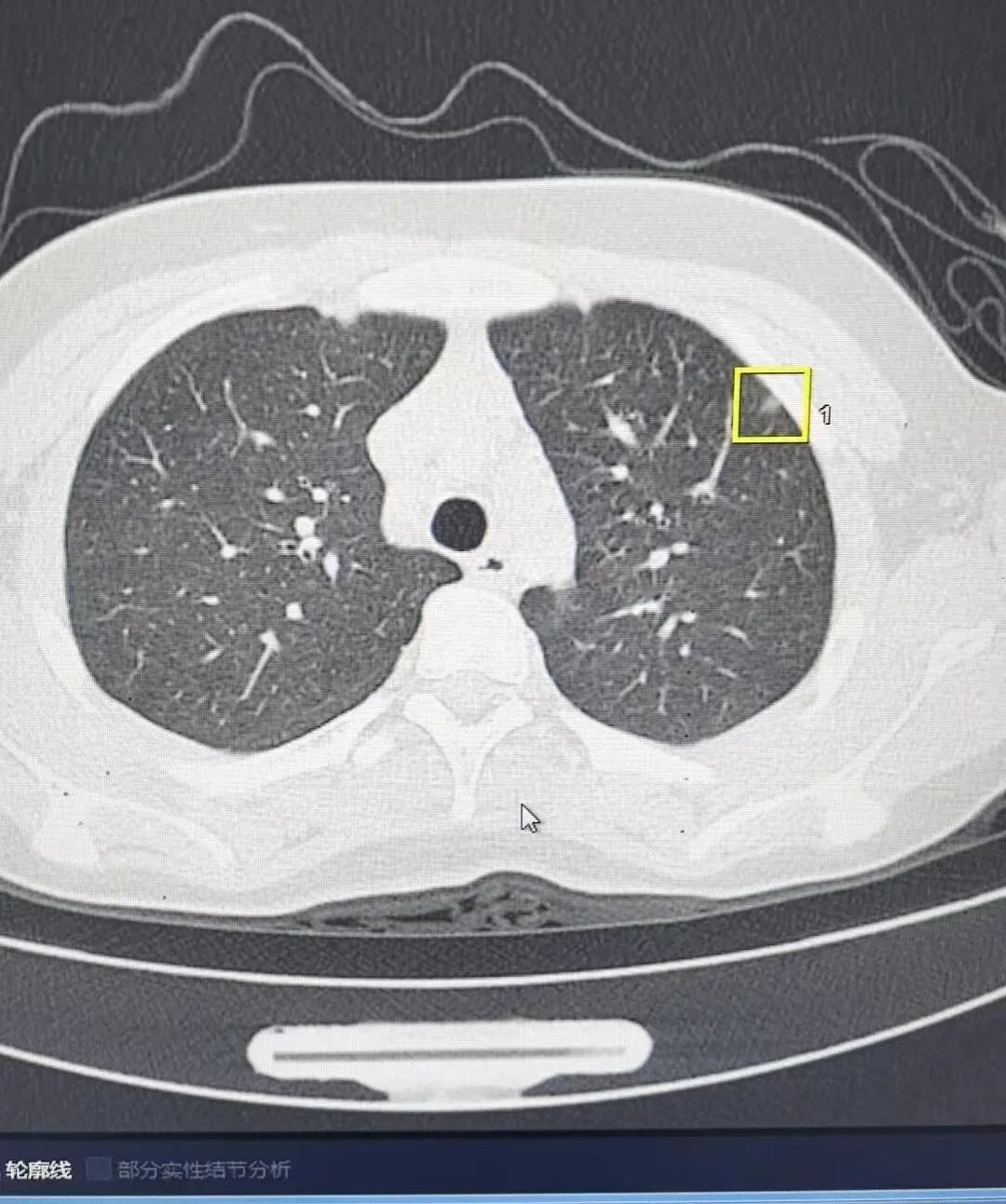 联影ct怎么样杞县中心医院影像诊断“利器”——联影高端螺旋CT_https://www.jmylbn.com_新闻资讯_第3张