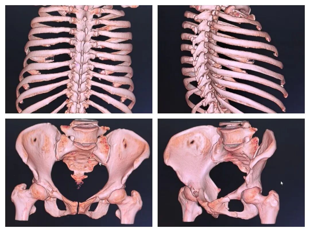 联影ct怎么样杞县中心医院影像诊断“利器”——联影高端螺旋CT_https://www.jmylbn.com_新闻资讯_第2张