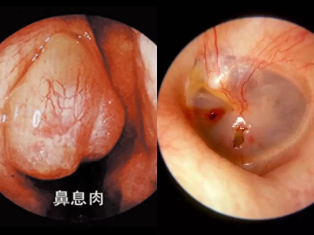 耳鼻喉内窥镜检查是检查什么什么是耳鼻喉内窥镜_https://www.jmylbn.com_新闻资讯_第7张