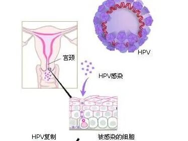hpvdna分型分为什么型人乳头瘤病毒(hpv)基因分型检测_https://www.jmylbn.com_新闻资讯_第2张