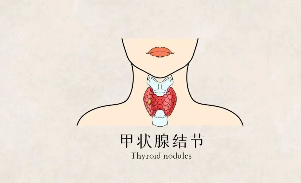 微波针是什么以“针”代“刀”，带你了解甲状腺结节微波消融术_https://www.jmylbn.com_新闻资讯_第4张