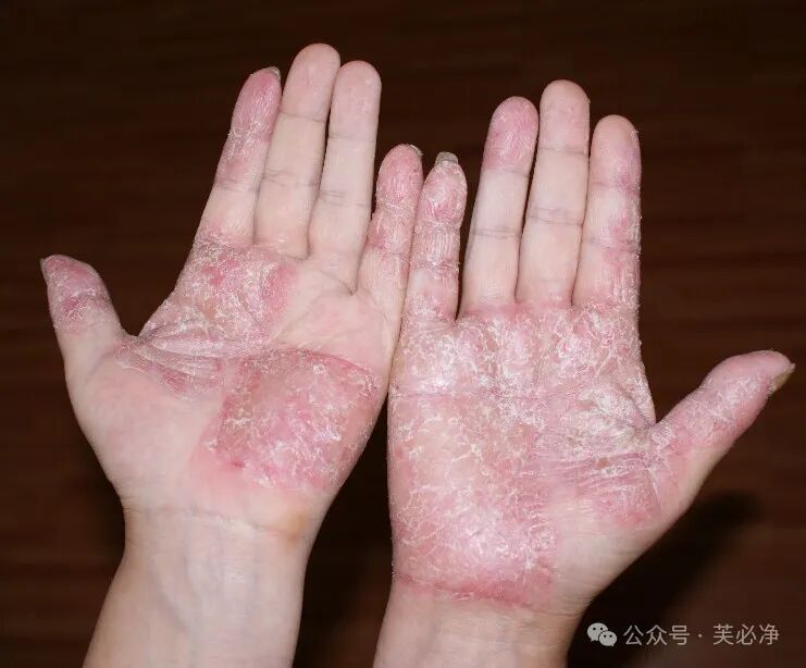 如何预防手足癣，摆脱它的困扰