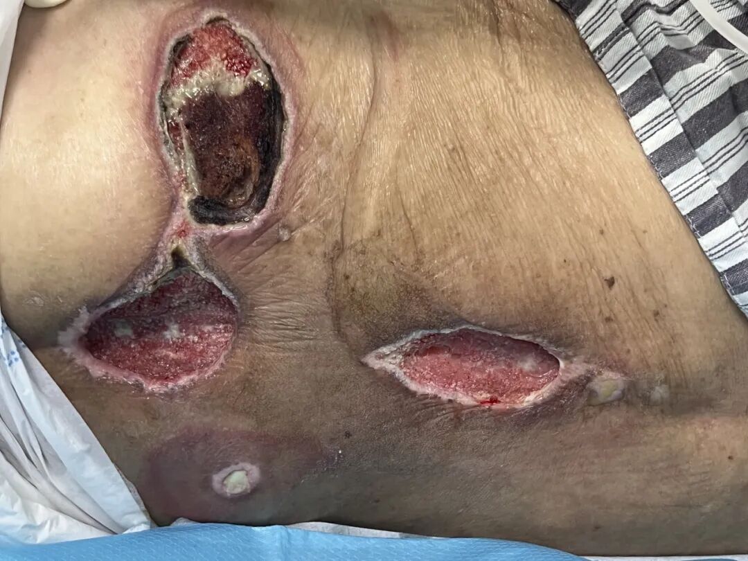 怎么促进vsd伤口愈合负压封闭引流术（VSD）：让伤口愈合更轻松_https://www.jmylbn.com_新闻资讯_第4张