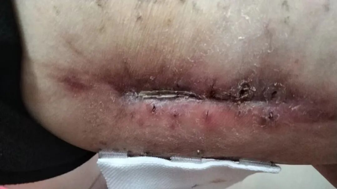 怎么促进vsd伤口愈合负压封闭引流术（VSD）：让伤口愈合更轻松_https://www.jmylbn.com_新闻资讯_第7张