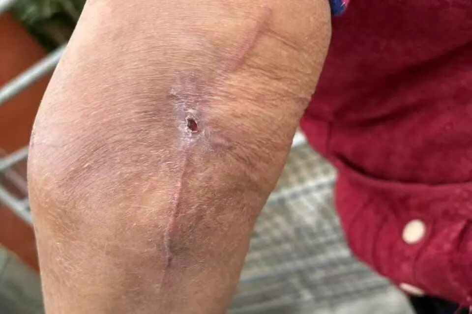 怎么促进vsd伤口愈合负压封闭引流术（VSD）：让伤口愈合更轻松_https://www.jmylbn.com_新闻资讯_第2张